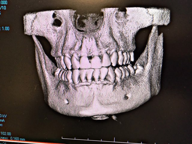CBCT