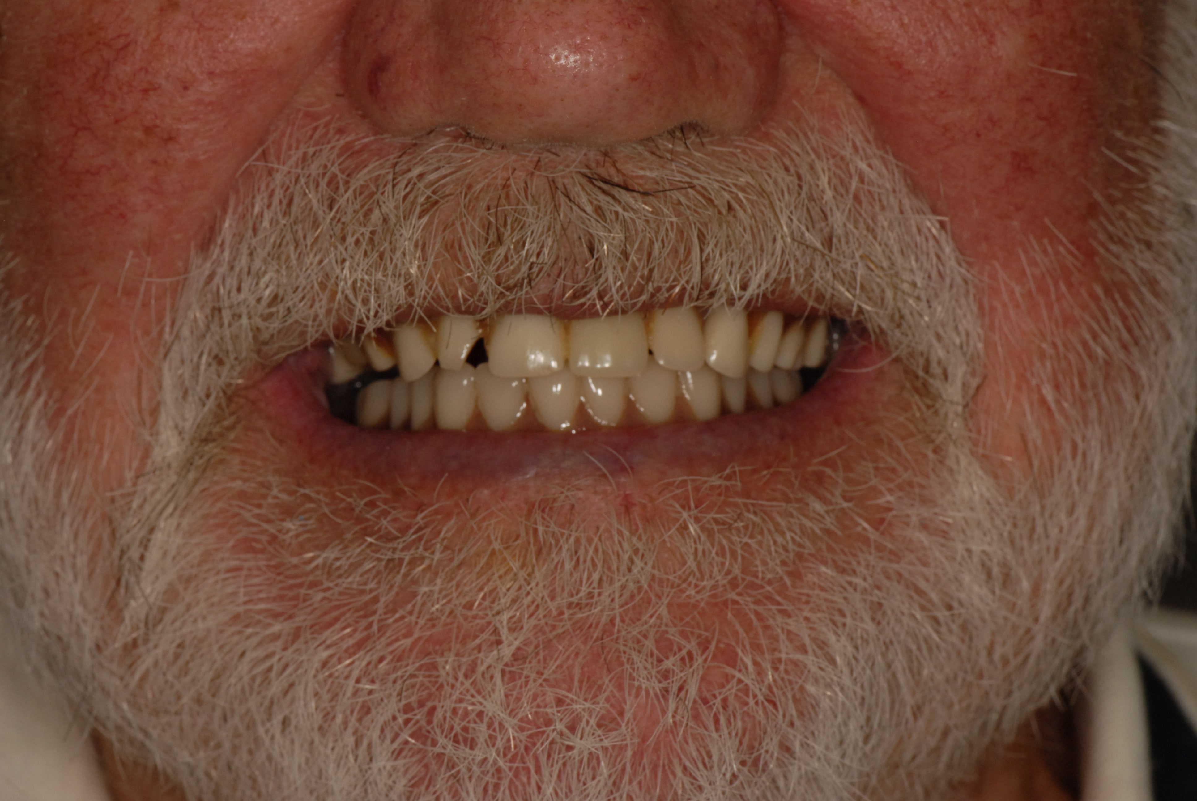 Denture2