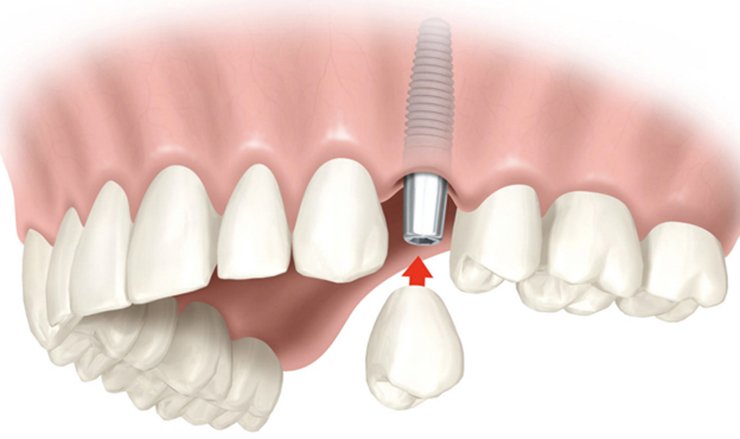 Dental Implants