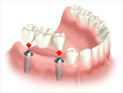 Implant Bridge