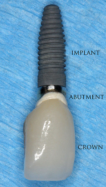 Implant Crown