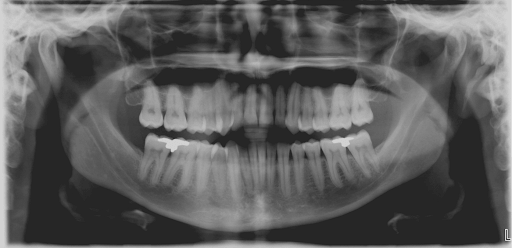 Panoramic Radiograph
