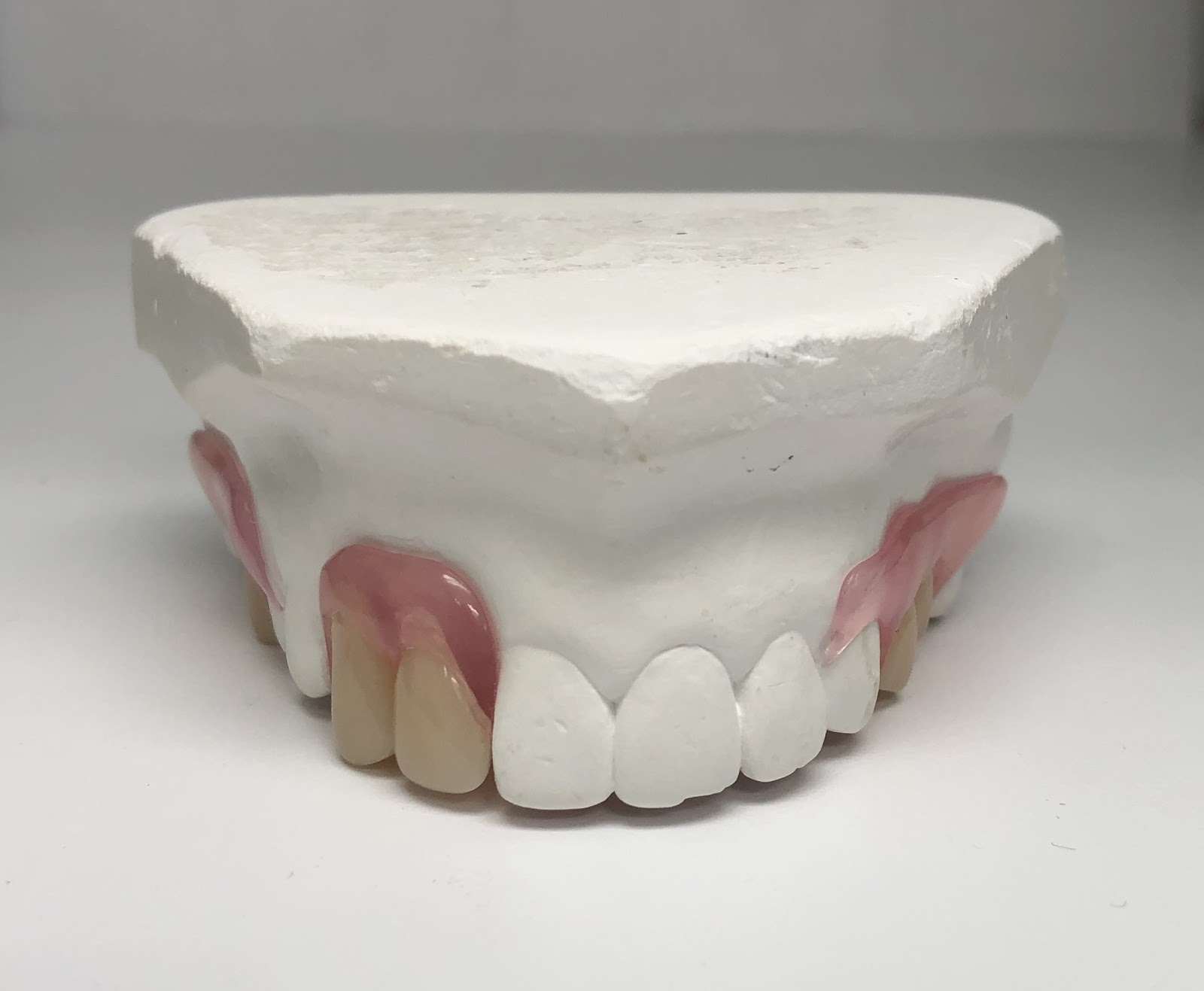 Partial Denture